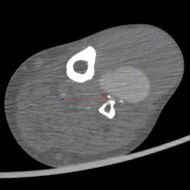 CTA showing the pseudoaneurysm at 75 mm (blue line) with both thrombus and contrast, and the patent anterior tibial artery (red arrow). Original magnification: 2000 × 2000 pixels.