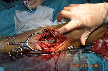 Temporary bleeding control ensured with Fogathy balloons in both ostia. Original magnification: 4288 × 2848 pixels.