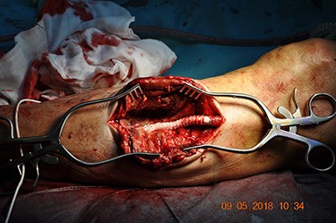 An 8 mm vascular graft anastomosed over the two ostia. Original magnification: 4288 × 2848 pixels.