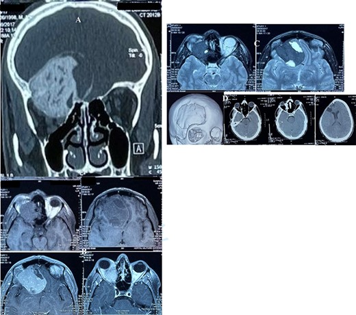 (A) CT scan, bone window, coronal reconstruction, showing well-defined ground glass lesion lying on the orbital roof invading the orbit and above the roof. (B) T1 weighted MRI images showing an expansile, heterogeneous and cystic lesion involving the orbital roof and invading the orbit below and the cranium above, with an enhancing after injection. (C) T2 weighted MRI images: the tumor is of a low intensity, whereas the cystic parts is hyperintense. (D) Postoperative CT scan, showing successful resection of the majority of the lesion.