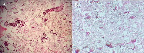 (A) Irregularly shaped bony trabeculae embedded within a moderately cellular fibrous stroma. Artifactual separation of the bony elements from the surrounding fibrous tissue also is seen (H&E, ×100). (B) Fibrous dysplasia.