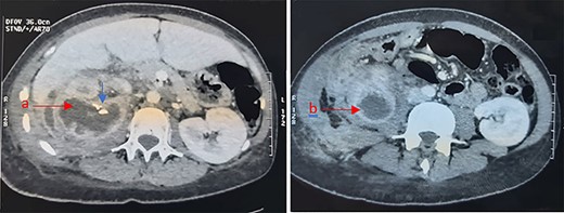 Abdominal CT showing a right renal multilocular collection, measuring 67 mm (a) with calcifications (Blue arrow) and a right para renal collection measuring 50 mm (b).