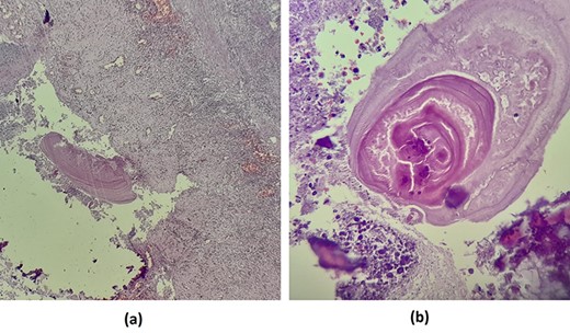 (a) Renal parenchyma with inflammatory reaction containing hydatid membranes (×10). (b) Eosinophil hydatid membranes and laminated acellular layers (×40).