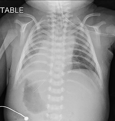 Pre-operative chest radiograph showed apparent dextrocardia and visceral situs inversus (evidenced by lower tip of feeding tube in the right-sided stomach with left-sided homogenous liver opacity).