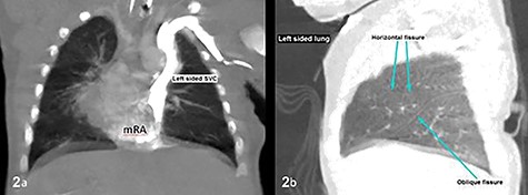 CT thorax confirmed atrial situs inversus whereby there was single left-sided SVC draining into the left-sided mRA as shown on coronal plane (a) and trilobed left lung as shown on sagittal plane in lung window (b). The pulmonary veins drain into the right-sided mLA (image not shown). Inferior vena cava was poorly demonstrable. SVC, superior vena cava; mRA, morphologic right atrium; mLA, morphologic left atrium.