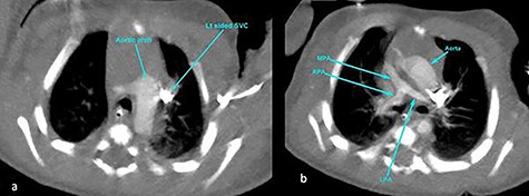 CT angiography thorax showing the left-sided aortic arch (a) and inverse relationship between ascending aorta and pulmonary artery. The MPA origin is atretic with hypoplastic RPA and LPA compared with the aorta (b). SVC, superior vena cava; RPA, right pulmonary artery; LPA, left pulmonary artery.