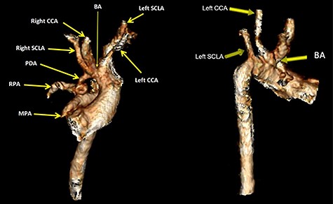 Volume rendered CT images demonstrates bovine aortic arch branches whereby the BA shares a common origin with the left CCA. The left SCLA arises separately as the last branch. The right PDA arises from the BA at pre-bifurcation and it connects inferiorly with the proximal RPA. The inferior end of PDA is tortuous. The MPA showed atretic origin. BA brachiocephalic artery, CCA, common carotid artery; SCLA, subclavian artery; RPA, right pulmonary artery.