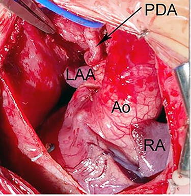 Intraoperative photograph shows dextrocardia with left aortic arch morphology. The PDA is tortous and arising from BA artery. Ao, Aorta; LAA, left atrial appendage; RA, right atrium.