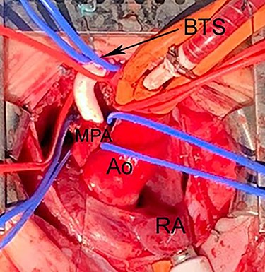 Intraoperative photograph shows Blalock-Taussig shunt between right BA and MPA. The PDA was divided under CPB to allow space for implantation of the shunt. Ao, Aorta; CPB, cardiopulmonary bypass; BTS, Blalock-Taussig shunt; CPB, cardiopulmonary bypass; LAA, left atrial appendage.