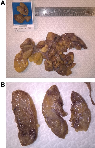 Surgical specimen showing a voluminous multilobulated with adipose appearance and texture, with a size of 7 × 7 cm.