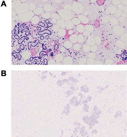 Pathological examination characterized by significant presence of fatty tissue with inside a cord proliferations of main and oncocytic cells, with sclerosis phenomena, and of lobular structures consisting of solid, cordal and microfollicular proliferations of parathyroid cells mixed with variable amounts of adipocytes.