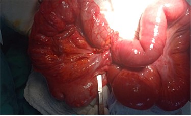 Contents of the hernia sac: cecum and ascending colon (right), herniated ileum through mesenteric defect (left).