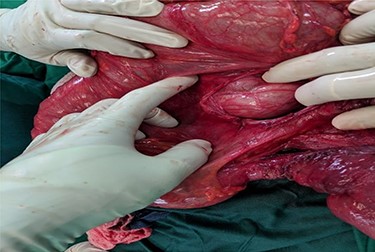 Mesenteric defect seen after ileum was reduced.