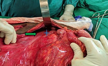 Narrow based, unfixed mesentery of right colon (arrow) with a right sided DJ flexure *.