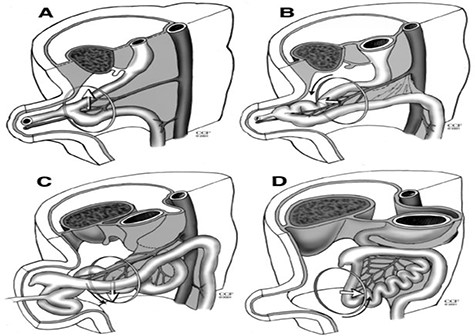 Diagram of normal intestinal rotation. (A) Primitive gut, (B) stage 1, (C) stage 2 and (D) stage 3.