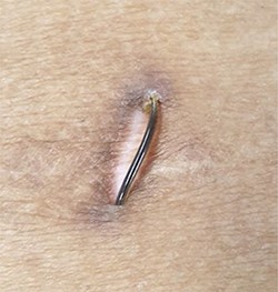 Wire eroding through the skin.