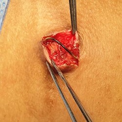 A small incision underneath the exposed wire revealing a clean healthy tissue.