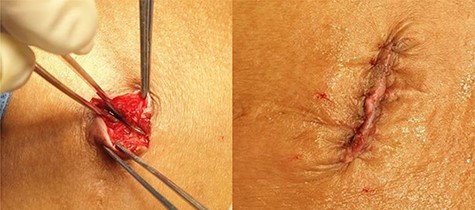 The wire buried and wound closed in two layers.