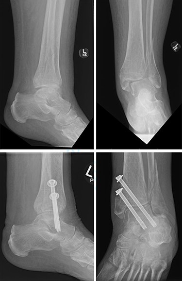 Top—Bimalleolar ankle fracture with talar shift. Bottom—Radiographs at 3 months follow-up showing maintained tibiotalar alignment.