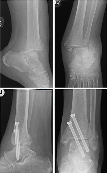 Top—Fracture dislocated bimalleolar ankle fracture. Bottom—6 weeks post-operatively showing maintained tibiotalar alignment.
