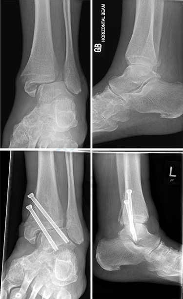 Top—Bimalleolar ankle fracture with talar shift. Bottom—Radiograph at 5 months showing small amount of talar shift.