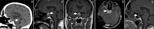 (A) Sagittal brain CT showing an isodense lesion in the pituitary gland associated with widening of the sella turcica. The lesion is causing a slight displacement of the pituitary stalk and optic chiam. (B–C) Sagittal and coronal sections of T1-weighted brain MRI without contrast. The MR images are demonstrating heterogneous signal of the pituitary lesion. The lesion is mainly hyperintense on T1-weighted images, indicating acute to subacute hemorrhage. The lesion is involving the sella and suprasellar region. (D) Axial T1-weighted brain MRI post contrast demonstrating enhancement of the pituitary lesion. (E) Sagittal MRI of the sella showing marked interval reduction in the size of the hemorrhagic cystic pituitary lesion. The small residual is measuring 1.1 × 0.5 cm. Interval resolution of the mass effect on the optic chiasm is noted.