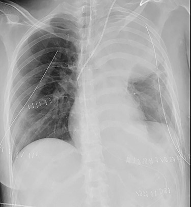Chest roentgenogram of 2 days after initial emergency operation.