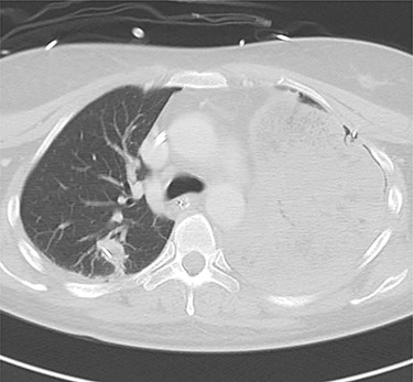 Computed tomography images of 2 days after initial emergency operation.
