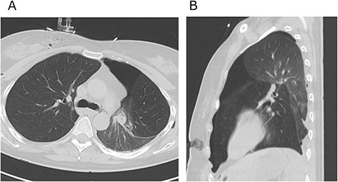 Axial (A) and sagittal (B) computed tomography images few hours after initial emergency operation.