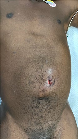 Anterior wall abdomen at presentation.