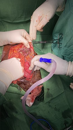Fascia defect.