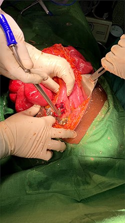 Gastric perforation.