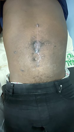 Anterior abdominal wall after 3 months of surgery.