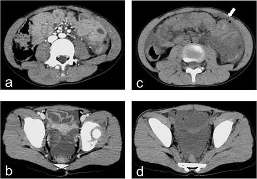 Enhanced and plain CT. (a) Enhanced CT on hospital day 1 demonstrates the absence of free air. (b) Enhanced CT on hospital day 1 demonstrates the presence of a fluid collection in the pelvic cavity. (c) Plain CT demonstrates free air in the left abdominal cavity. (d) Plain CT demonstrates a significant amount of fluid in the pelvic cavity.