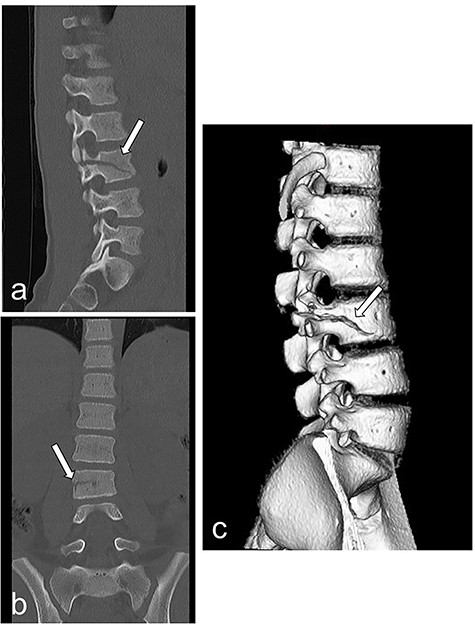Radiography and CT on hospital day 1. (a, b) Radiography shows fracture of the lumbar spine at L3. (c) CT shows a fracture of the lumbar spine at L3.