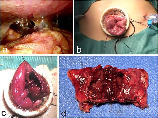 Intra-operative findings. (a–c) Exploratory laparoscopy reveals purulent ascites with intestinal adhesions and a ruptured jejunum. (d) A 10-cm segment of jejunum is excised.