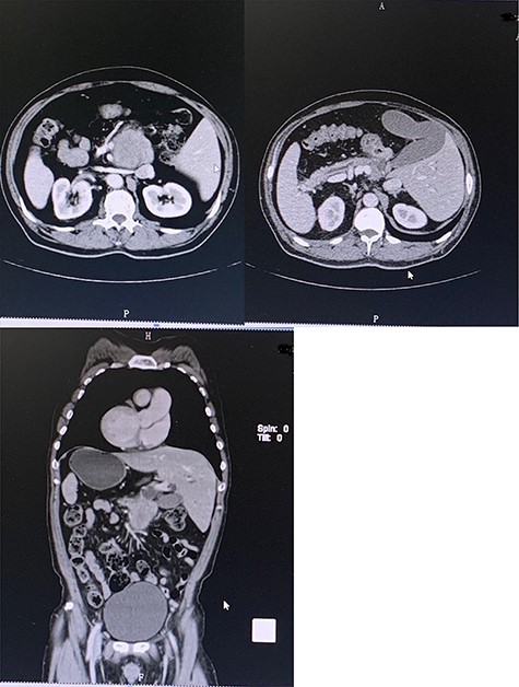 Preoperative contrast-enhanced CT confirming SIT with space-occupying at the head of pancreas and duodenum.