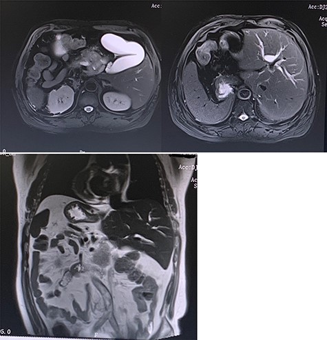 Preoperative MRI (T2 phase) confirming the SIT and showing the intrahepatic bile ducts dilation and the enlarged gallbladder with a space-occupying at the head of the pancreas.