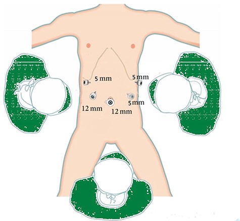 Showing the position of the chief surgeon (right side of the patient) with his assistants, the laparoscope hole below the umbilicus and four trocars holes were placed at the right and left abdomen.