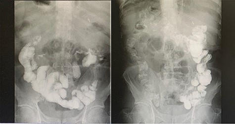 Left-image is postoperative fluoroscopy confirming smooth passage of contrast in the remnant stomach and the gastrojejunostomy with no stenosis or flaccidity; Right-image confirming smooth passage of contrast in the choledochojejunostomy and pancreaticojejunostomy.