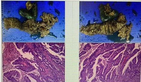 Shows the postoperative specimen and pathology report.