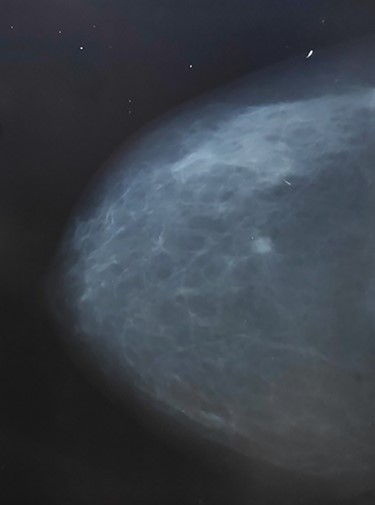 Mammogram shows braids 4 suspicious mass at left upper quadrant (lt breast).