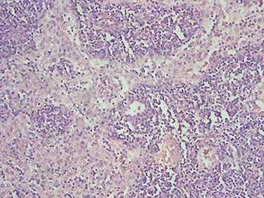 H&E microscopic appearance of IDC (200 times magnification).