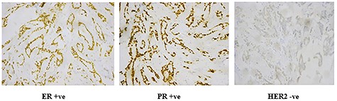 Immunohistochemistry of IDC; processed in Ventana and stained by rabbit monoclonal antibodies using DAB as chromogen and hematoxylin as counterstain; (A) ER receptors (+ve nuclear staining by chromogen); (B) PR receptors (+ve nuclear staining by chromogen); (C) HER2 (−ve cell membrane staining).