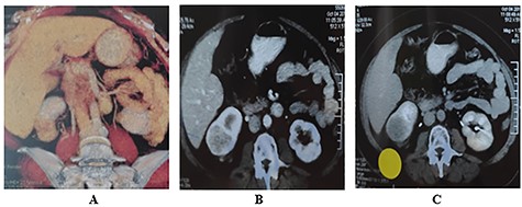 Triphasic multi-slice pelvi-abdominal CT scan showing exophytic mass at the lower pole of Rt Kidney; (A) Colored 2D CT reconstruction; (B) Enhancement of tumor in the arterial phase; (C) Fading out of the contrast in the venous phase.