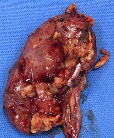 Specimen of Rt lower pole mass after radical nephrectomy.