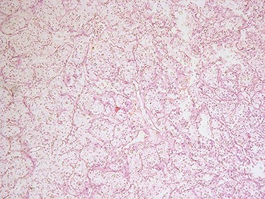 H&E microscopic appearance of clear cell renal carcinoma (100 times magnification).