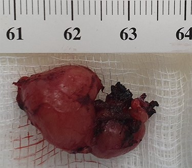 Well-circumscribed and lobulated lymph node measuring 2.5 cm × 1.5 cm.