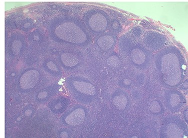 Histopathology of the lymph node showing follicular and germinal center hyperplasia. Haematoxylin and Eosin stain. Magnification ×1.2.