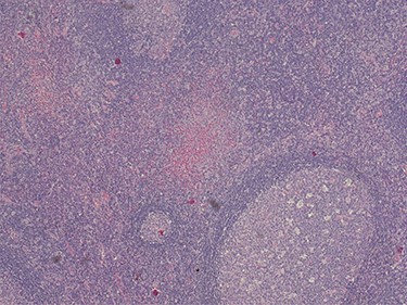 Histopathology of the lymph node showing paracortical expansion by plasma cells, small lymphocytes and mast cells, and areas containing eosinophilic micro-abscesses (accumulation of inter-follicular eosinophils). Haematoxylin and Eosin stain. Magnification ×5.